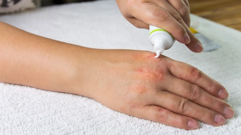 Gereizte Haut (Quelle: Getty Images/Marina Vol) Eine junge Frau hält eine Tube mit Salbe in einer Hand. Sie trägt etwas Salbe auf eine gerötete und leicht schuppige Hautstelle an der anderen Hand auf.