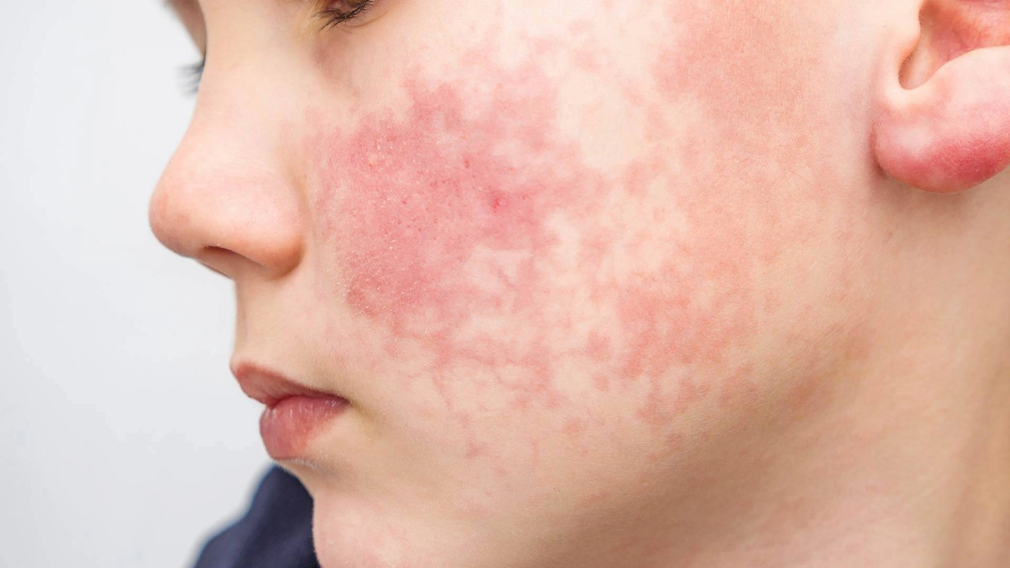 Erythema Infectiosum Lacy Rash