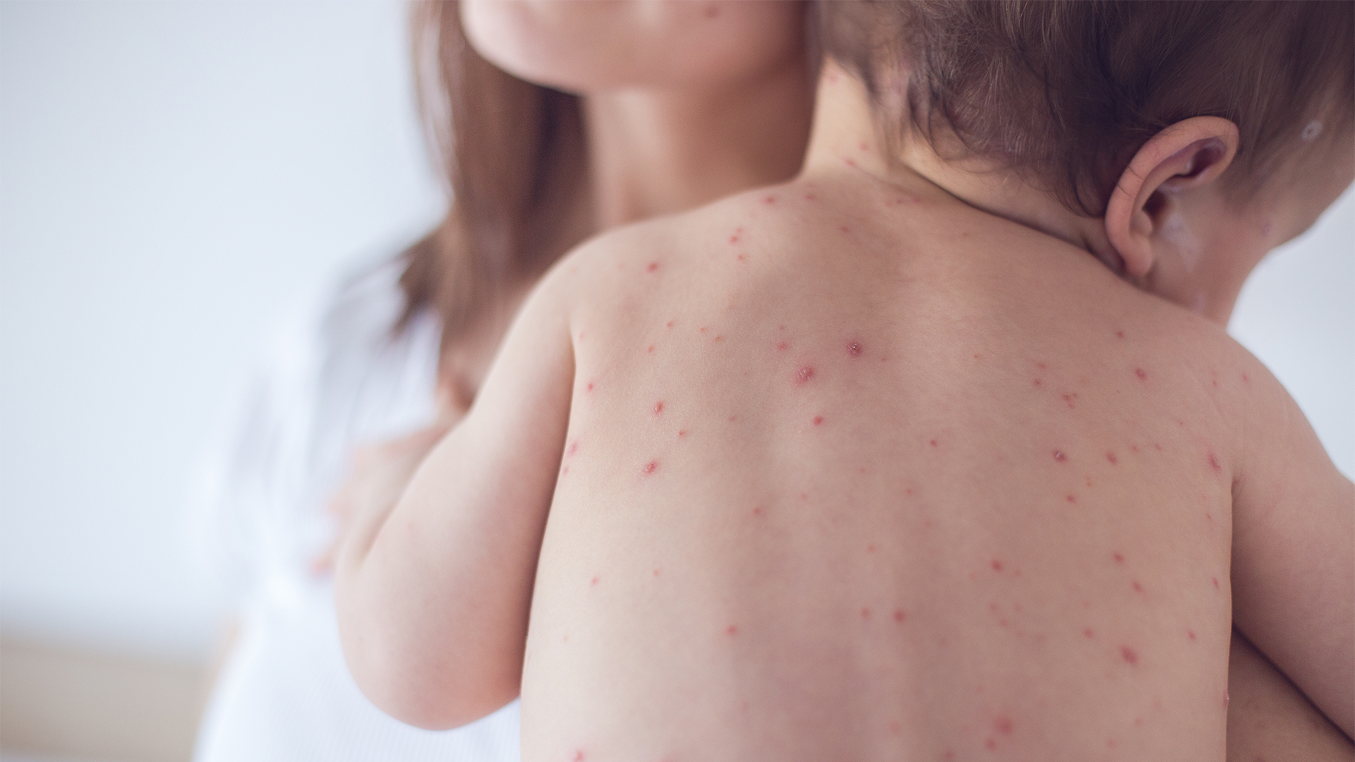 R teln Symptome Therapie Und Vorbeugung Gesund bund de